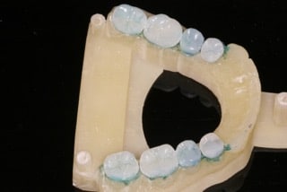 OVC3 case study mould of mouth with crowns