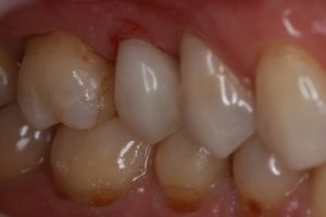 OVC3 Case study very little remaining tooth structure after from side