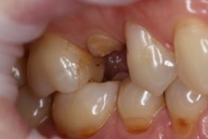 OVC3 Case study very little remaining tooth structure before from side