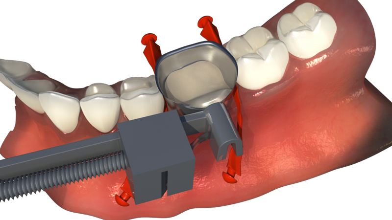 OVC3 Matrix Band & Stretch Wedge