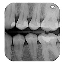 Figure 1. Open contact between upper premolars.